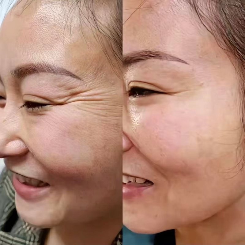 去皱纹